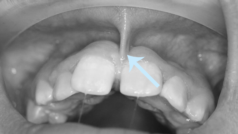 diastema espaço entre os dentes freio labial