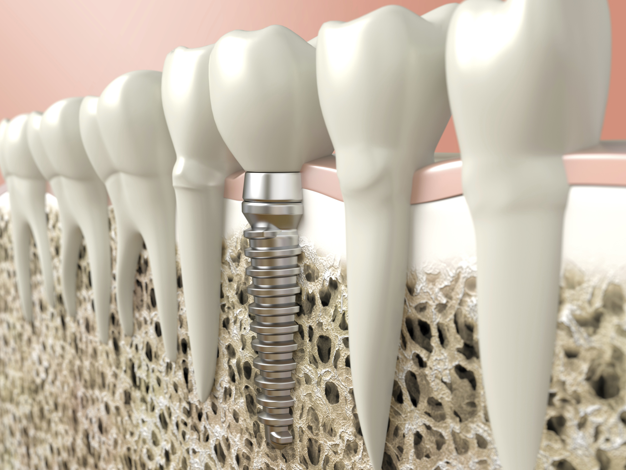 Implantes dentários. Simulação digital de um implante dentário unitário osseointegrado.