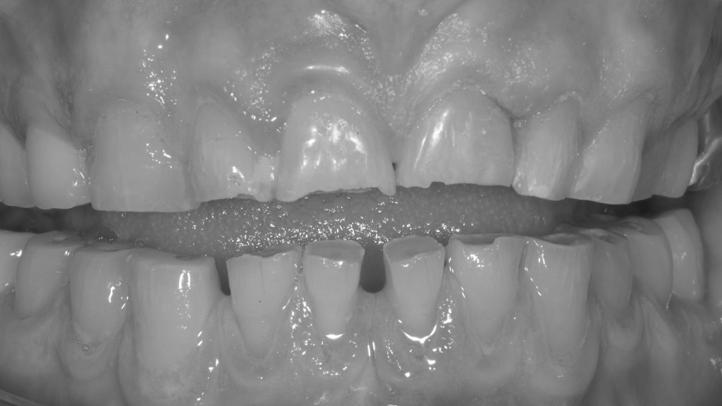 Bruxismo e recuperação de dentes desgastados #8