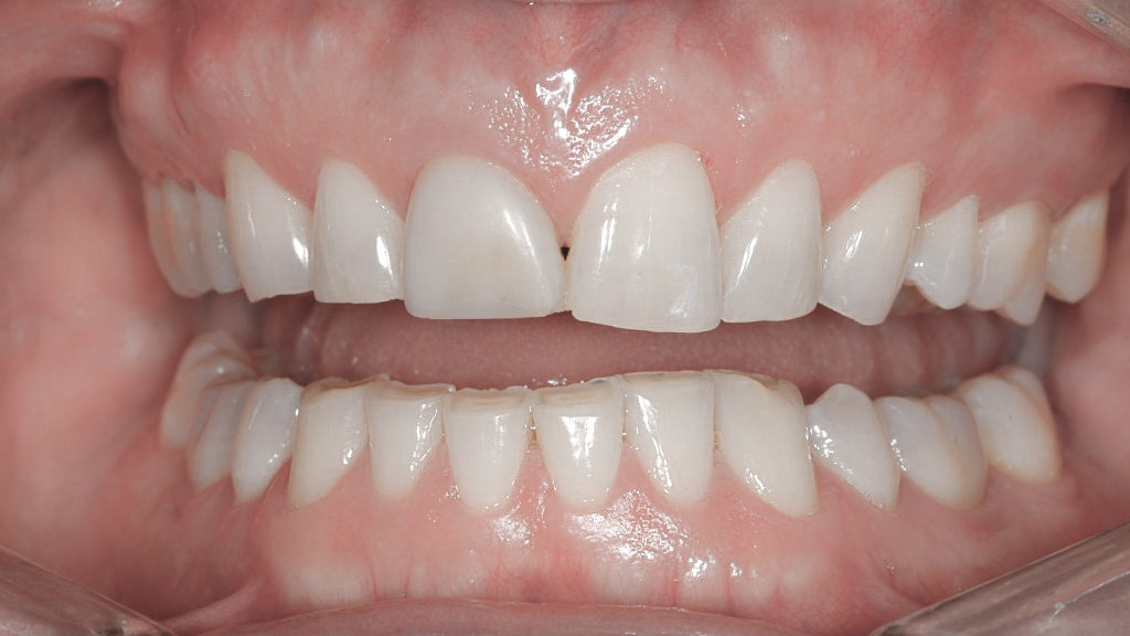 bruxismo e recuperação de dentes desgastados capa