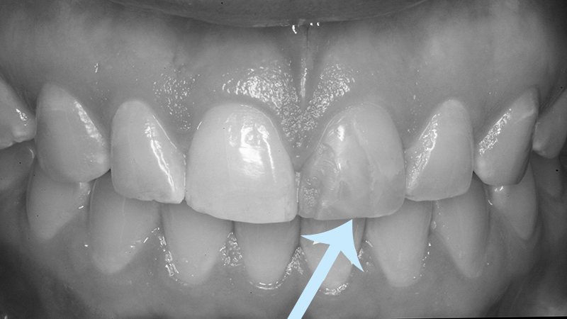dente-escurecido-tratamento-canal-resina
