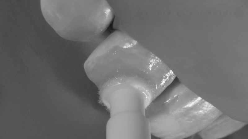 escurecimento dentario após tratamento de canal facetas em resina