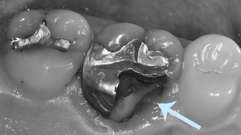 restauração dental em amálgama de prata quebrada