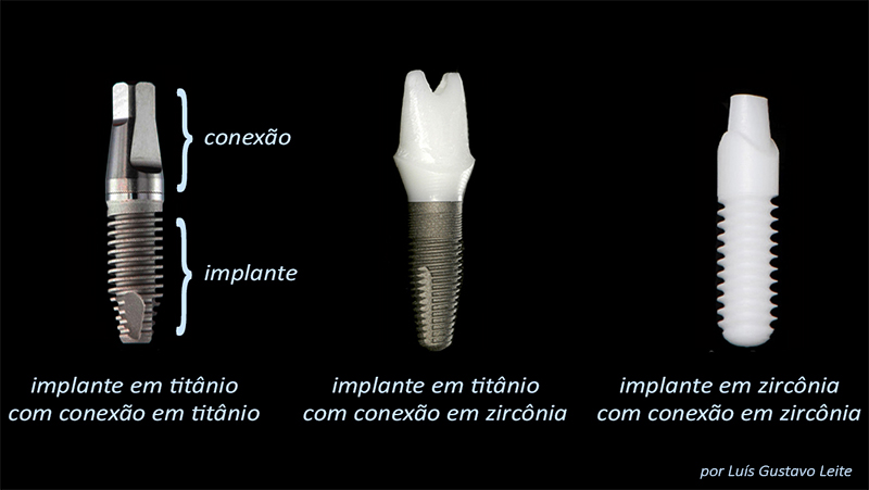 estetica-em-protese-dentaria-sobre-implante-pilares