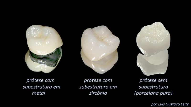estetica-em-protese-dentaria-sobre-implante-tipos