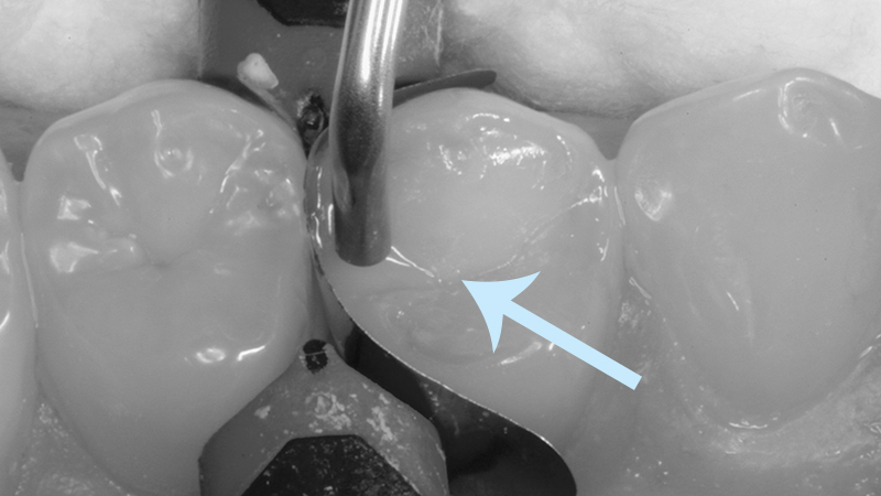 restauração dentária em resina dente posterior