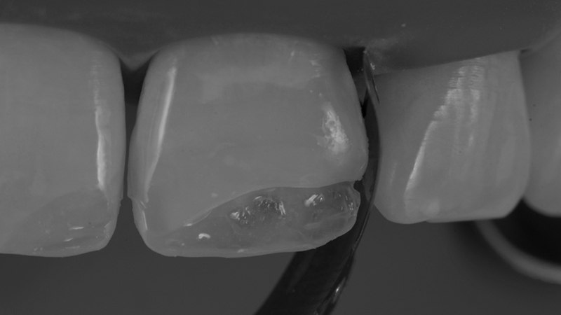 troca-restauração-dentes-anteriores-resinas