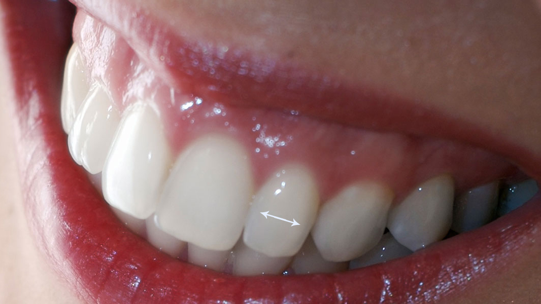 sorriso-gengival-alto-dentes-alongados-cirurgia-facetas-e-lentes