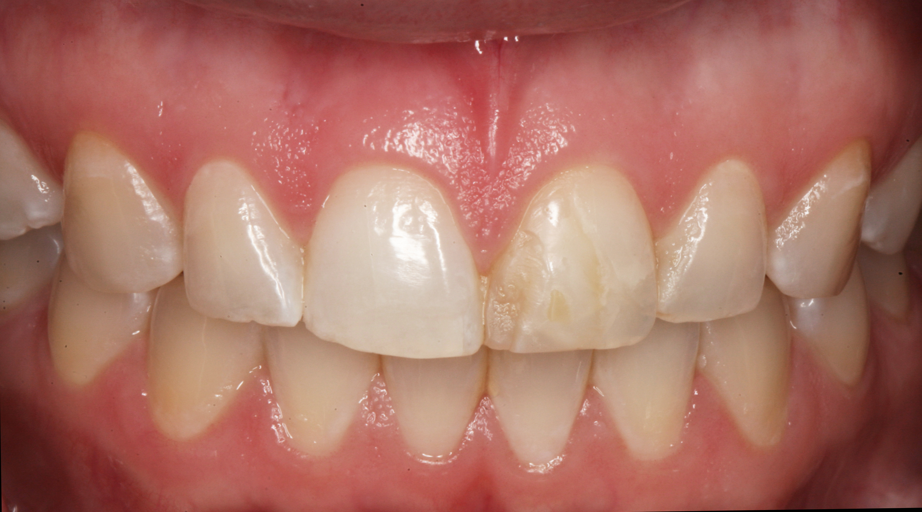 Clareamento dental caseiro e laser restauração amarelada
