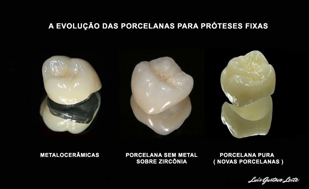 Novas porcelanas : mais translucidez e naturalidade na reprodução das cores dentárias.