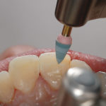 Reconstrução com resina em dente anterior fraturado.