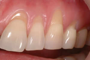 cirurgia de gengiva retra\u00edda #1 - Lu\u00eds Gustavo Leite - dentista ...