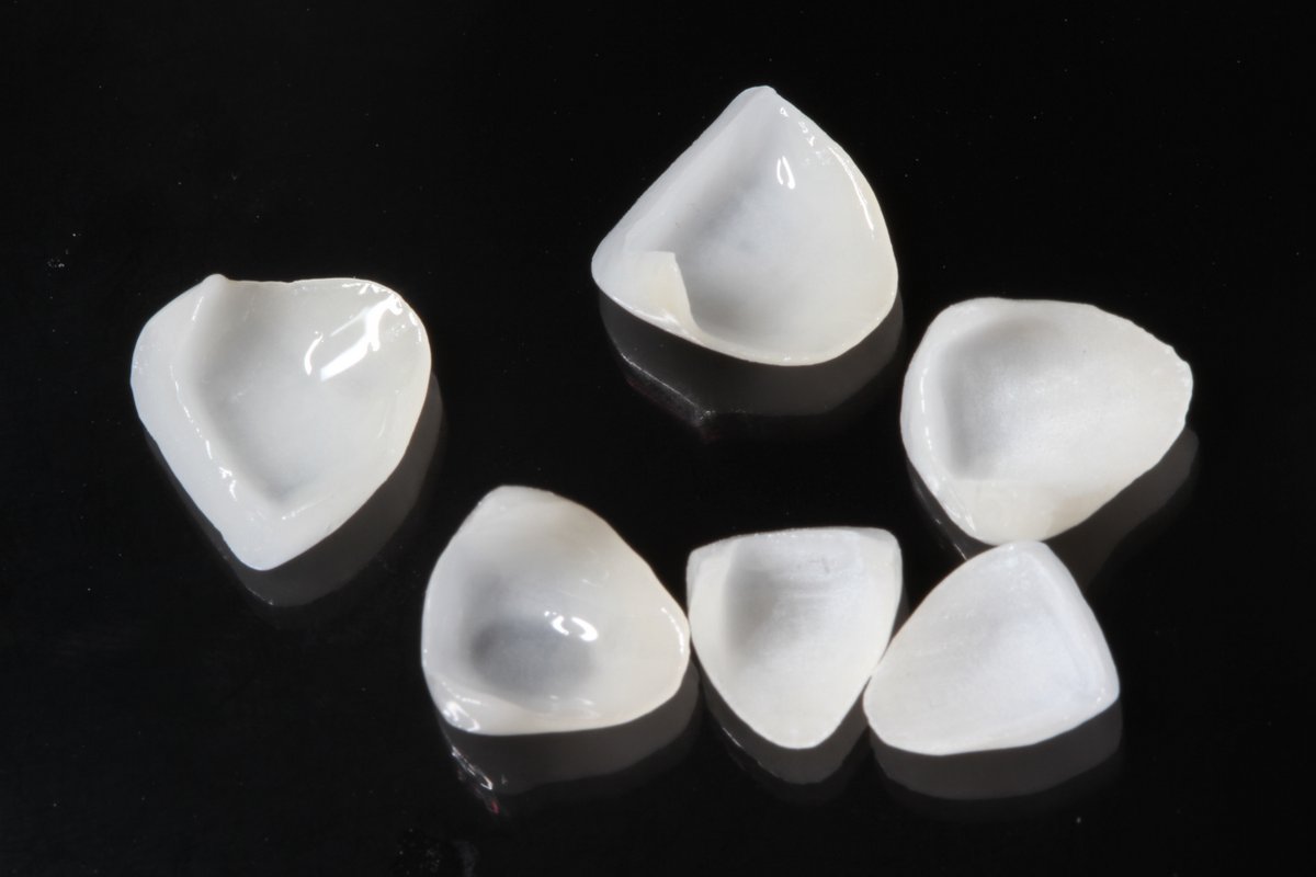 Os fragmentos cerâmicos não necessitam recobrir todo o dente para solucionar problemas estéticos de forma.