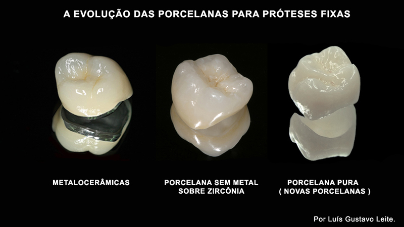 proteses-dentarias-fixas-com-porcelana-pura
