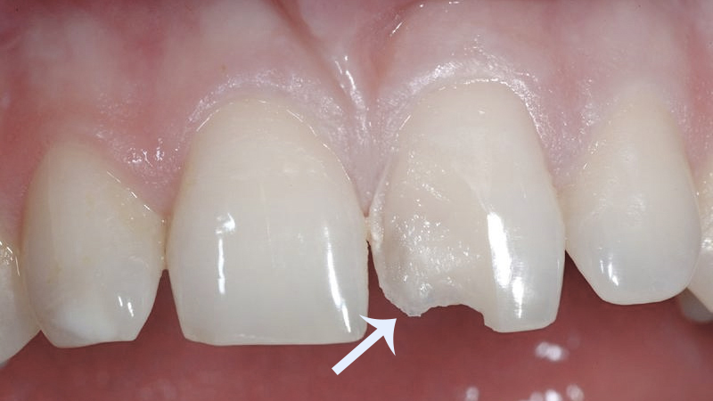 lente de contato dental e fragmento ceramico