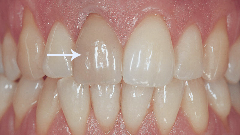 clareamento dental caseiro e laser