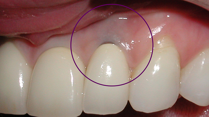 prótese dentária em porcelana tipos gengiva