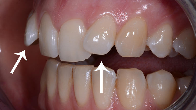 tratamento dente torto e girado com facetas e laminas inclinação excessiva