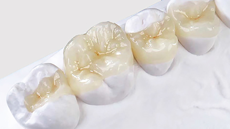 restauracao-dental-em-porcelana-blog
