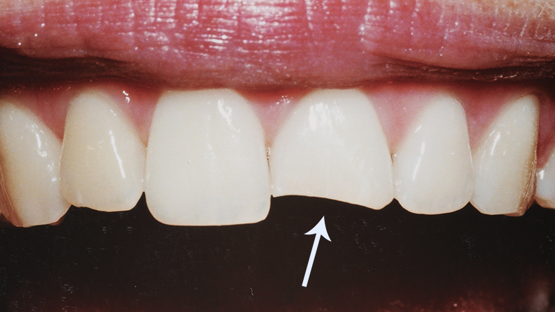 restauracao-dental-em-porcelana-dente-anterior