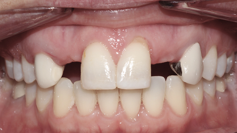 tratamento com prótese e aparelho ortodontico agenesia