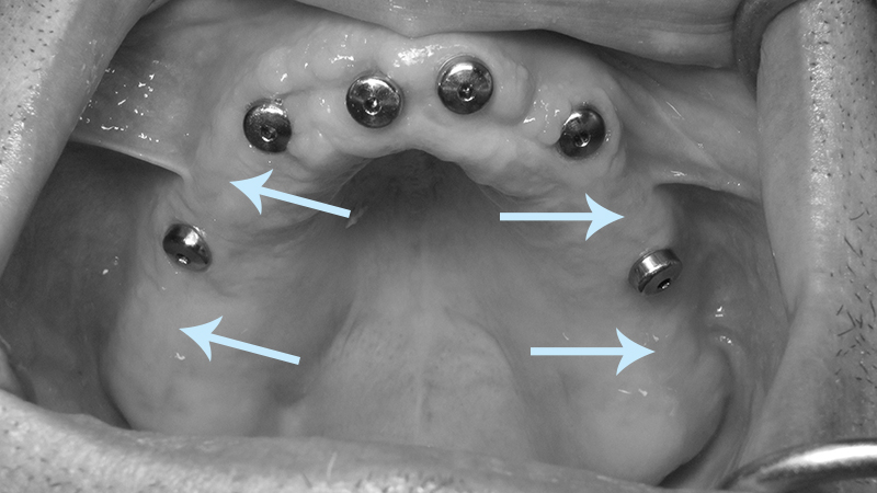 tratamento dentadura e implante dental
