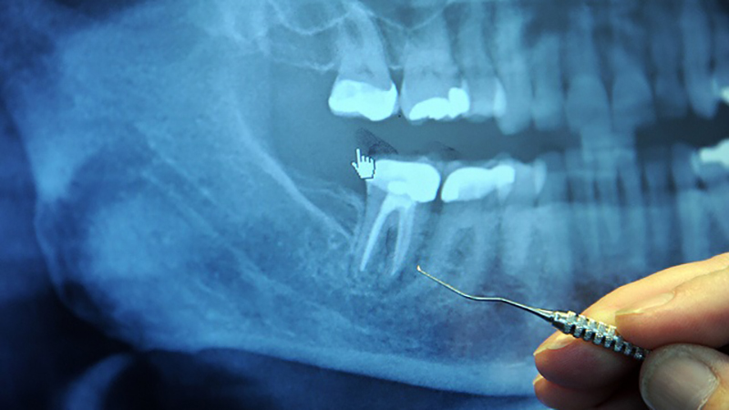 raiz dentária em prótese dentária
