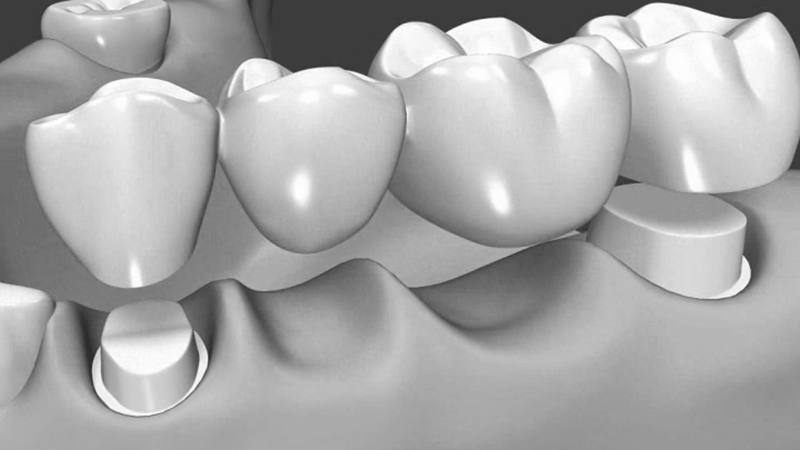 prótese dentária em zircônia extenso