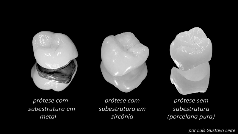 prótese dentária em zircônia quadro comparativo