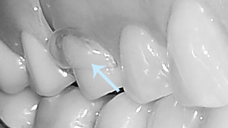 prótese dentária flexível grampo transparente