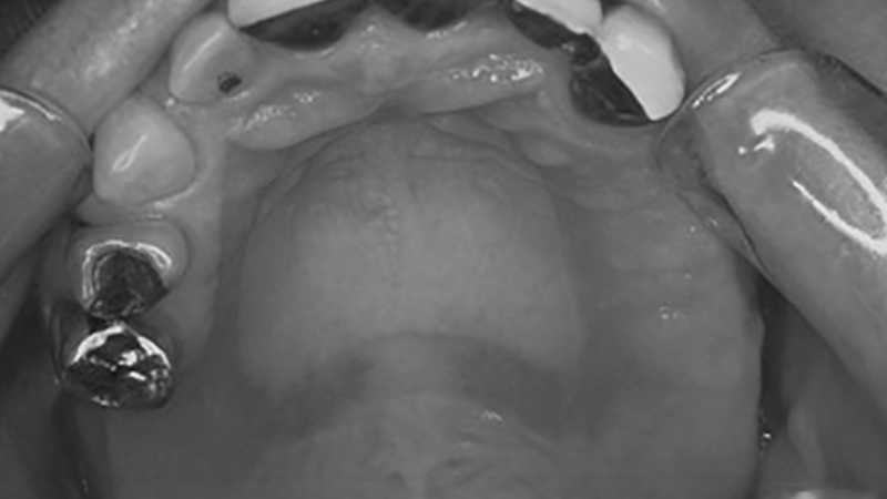 prótese dentária removível trauma