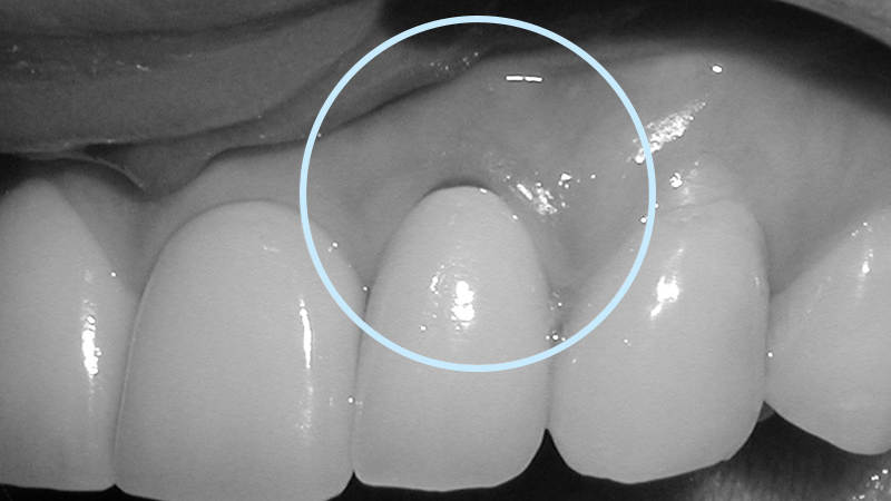 prótese dentária em resina acrílica zircônia porcelana retração