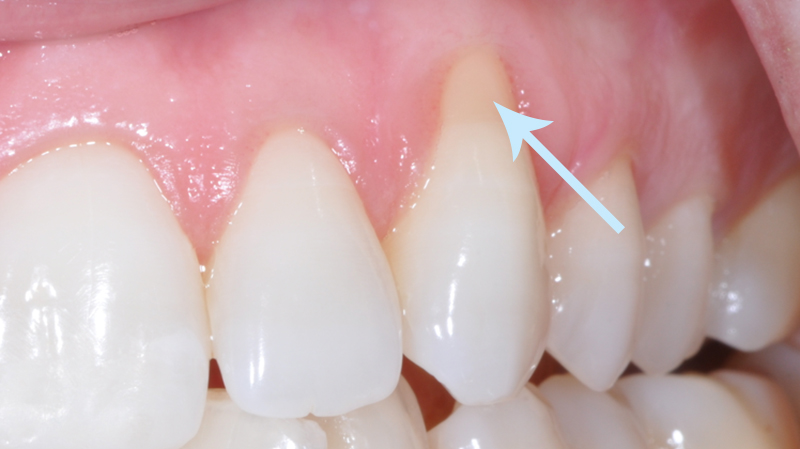 clareamento dental tipos recessão gengival