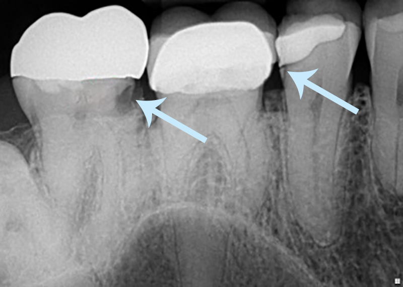 infiltração por cárie dentária em coroa dentária