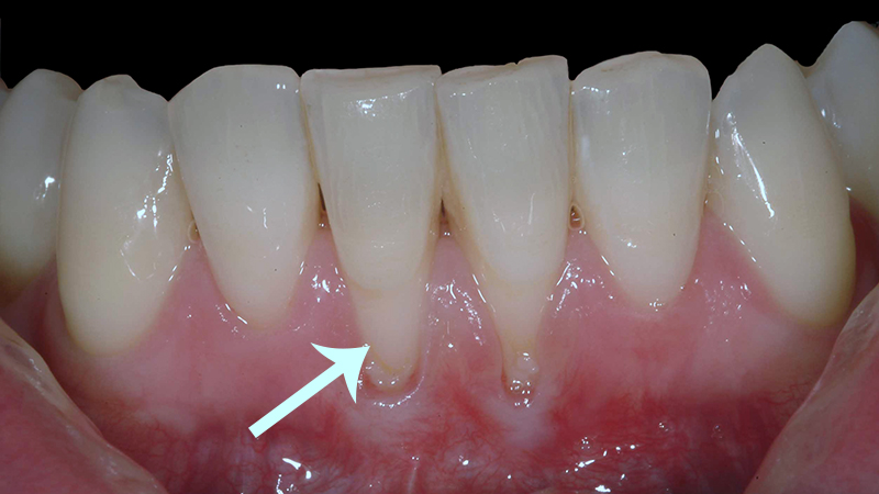 retração gengival tratamento ortodôntico dentes incisivos inferiores