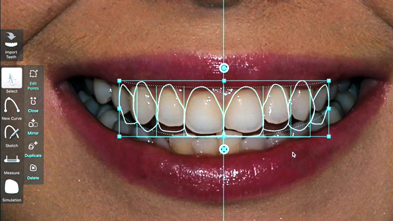 simulação digital lentes de contato dental