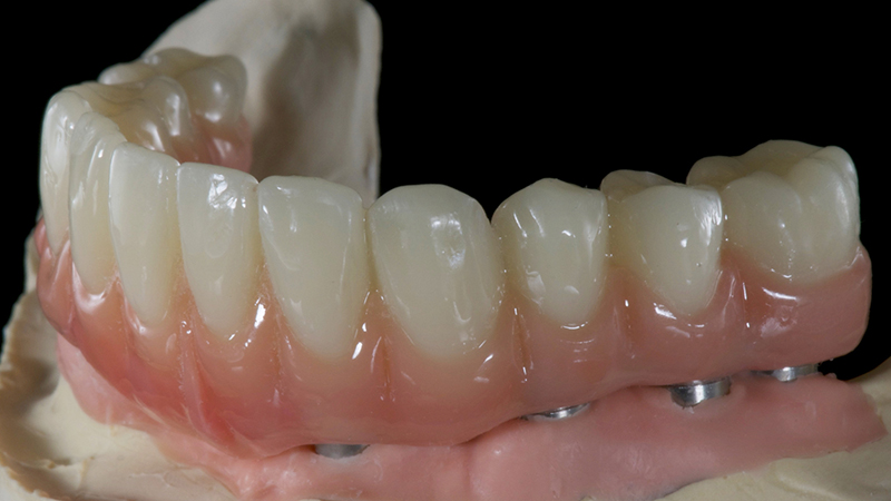 dentadura fixa em acrílico e implante dentário