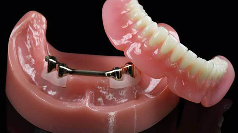 prótese dentária protocolo acrílico
