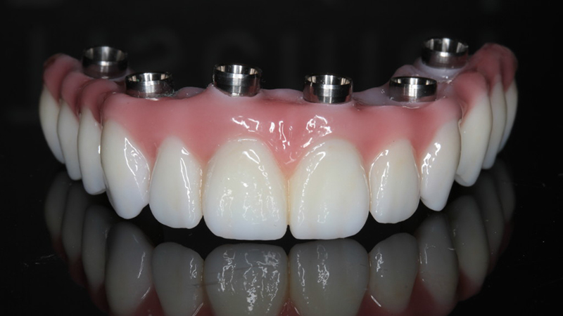 prótese dentária protocolo porcelana com metal