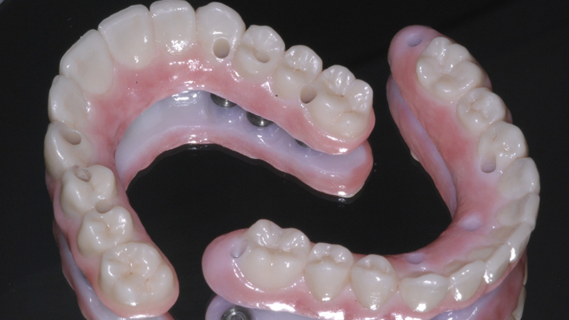 prótese dentária protocolo zircônia