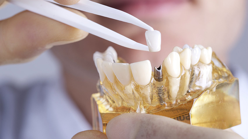 protese dentaria fixa implante porcelana
