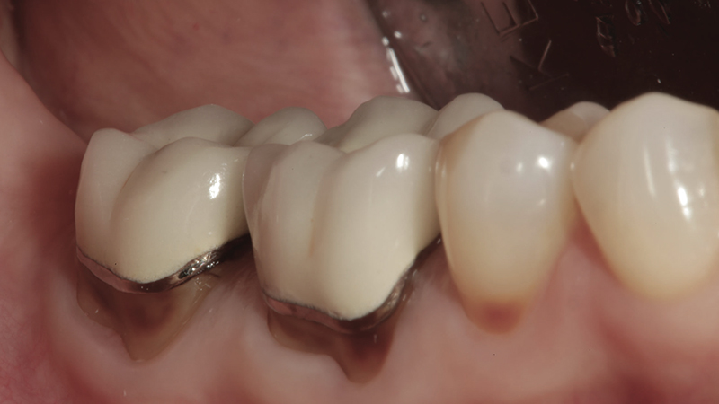 prótese dentária em metal trocar
