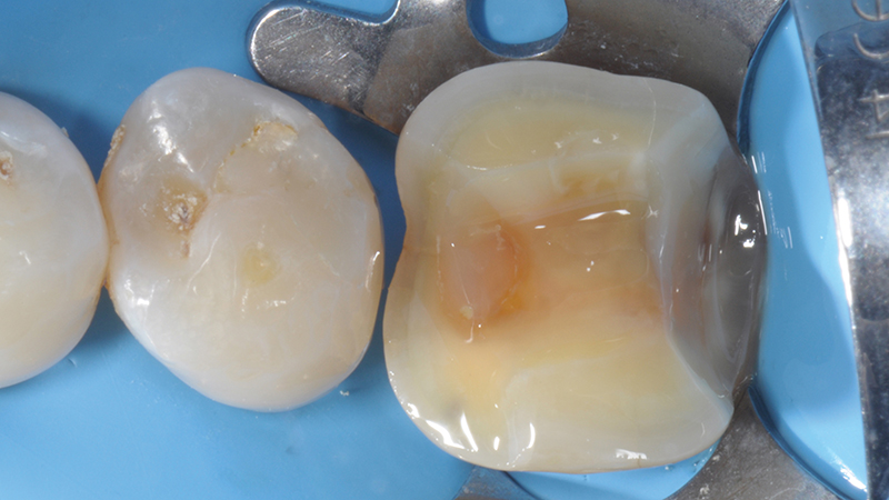 restaruração em porcelana dentes posteriores extensão