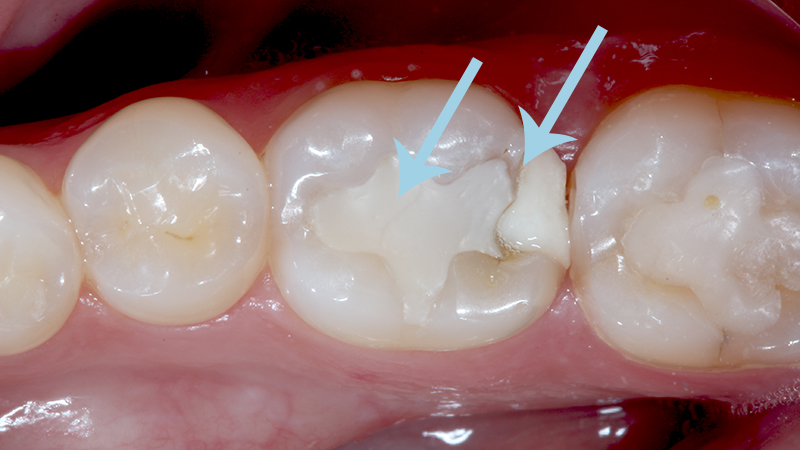 restauração dentaria em resina problemas