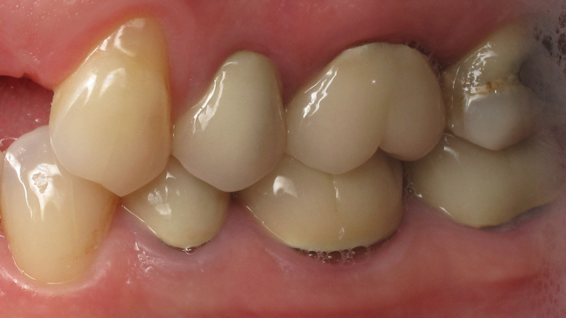 trocar coroa dentária prótese dente posterior