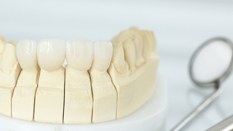 7 dicas para trocar prótese dentária fixa