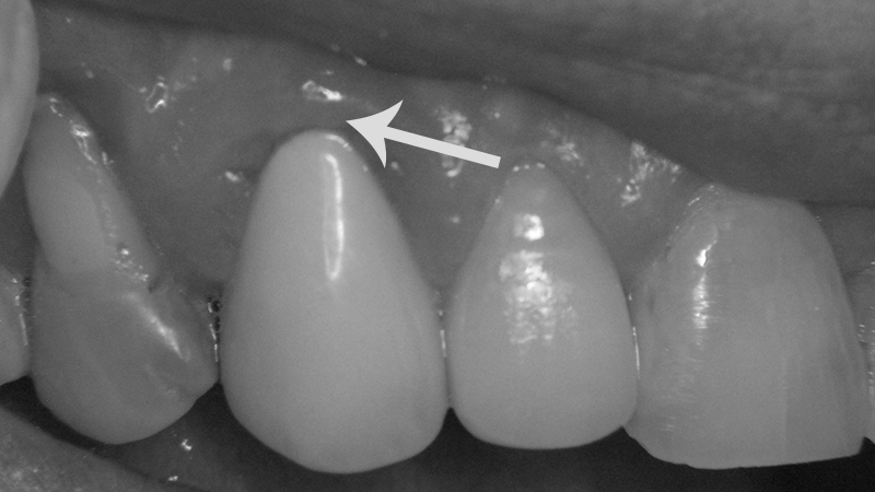 inflamação gengival trocar prótese dentária