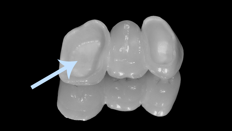 prótese dentária fixa em zircônia pòntico