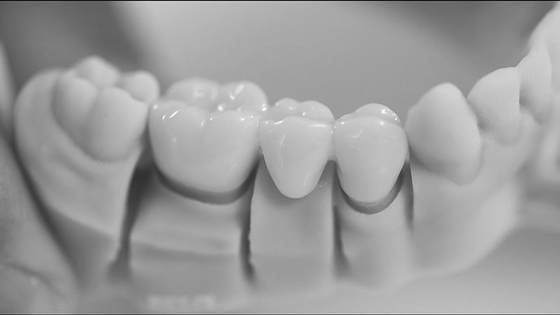 prótese dentária provisória tipo pôntico