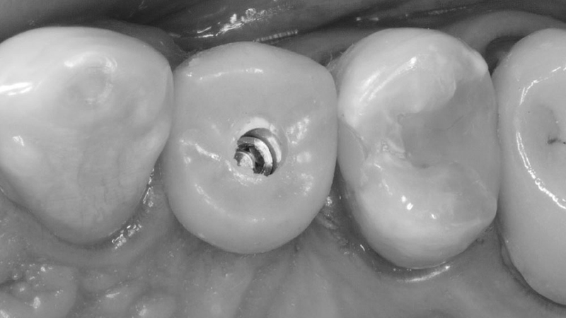 prótese provisória implante dentário